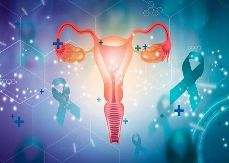 افزایش ۴ برابری احتمال سرطان تخمدان در زنان مبتلا به اندومتریوز