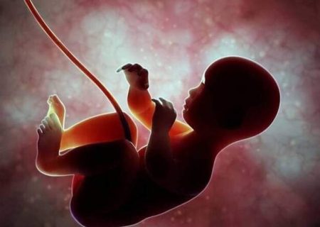 بیانیه وزارت بهداشت درباره سقط جنین مبتلا به سندروم داون